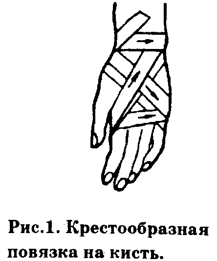 Крестообразная повязка