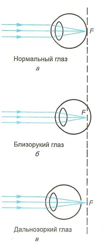 Схема близорукого глаза